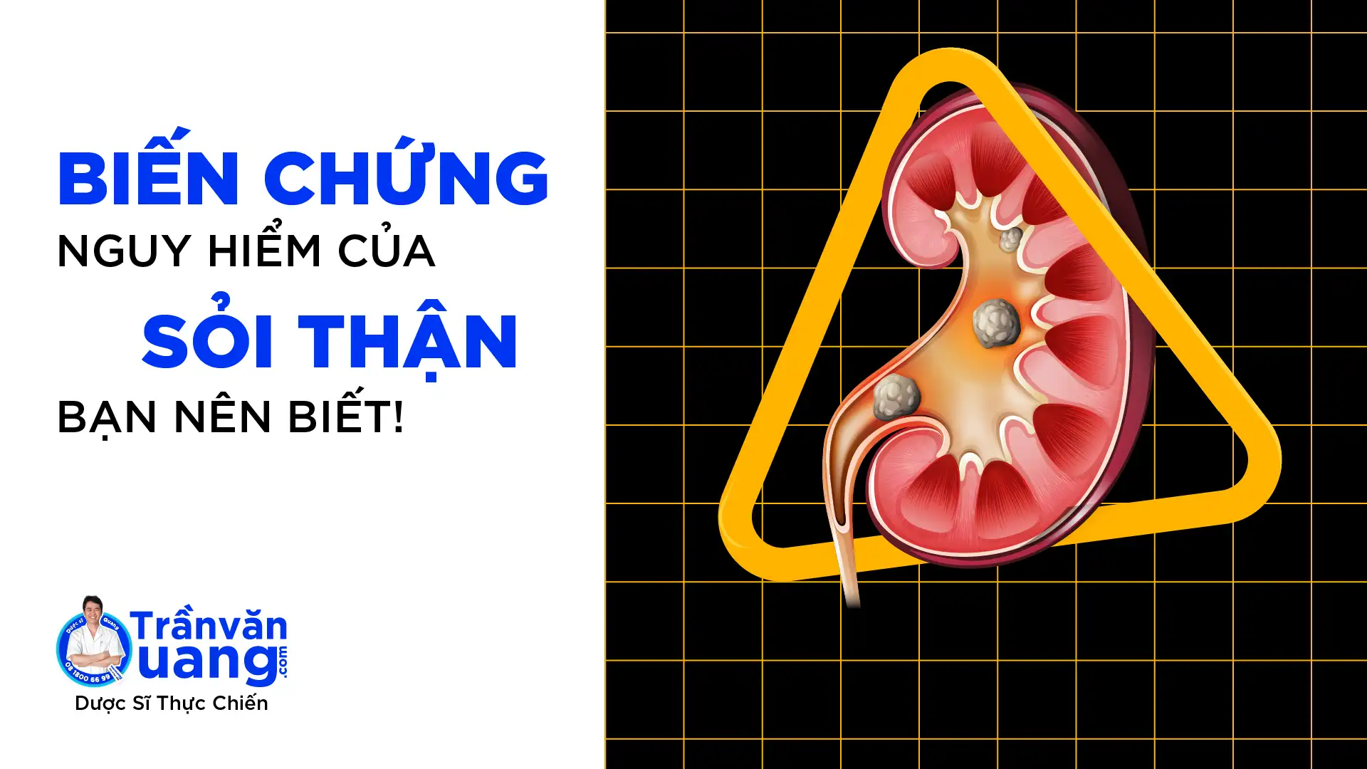 Sỏi thận có sao không - Biến chứng của sỏi thận là gì?